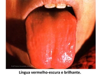 Profª Karen Fernandes Andrade



          Língua vermelho-escura e brilhante.
 