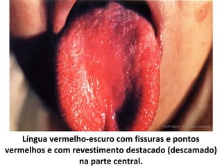 Profª Karen Fernandes Andrade


    Língua vermelho-escuro com fissuras e pontos
vermelhos e com revestimento destacado (descamado)
                  na parte central.
 