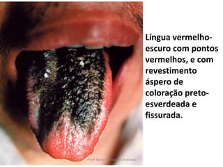 Língua vermelho-
                                escuro com pontos
                                vermelhos, e com
                                revestimento
                                áspero de
                                coloração preto-
                                esverdeada e
                                fissurada.



Profª Karen Fernandes Andrade
 
