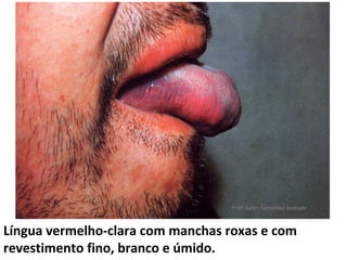 Profª Karen Fernandes Andrade



Língua vermelho-clara com manchas roxas e com
revestimento fino, branco e úmido.
 