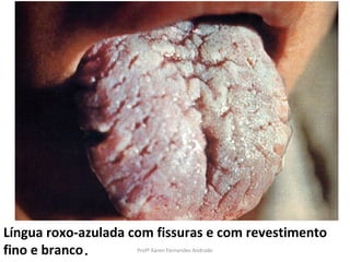 Língua roxo-azulada com fissuras e com revestimento
fino e branco.       Profª Karen Fernandes Andrade
 