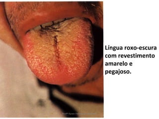 Língua roxo-escura
                                com revestimento
                                amarelo e
                                pegajoso.




Profª Karen Fernandes Andrade
 