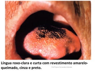 Língua roxo-clara e curta com revestimento amarelo-
queimado, cinza e preto.     Profª Karen Fernandes Andrade
 