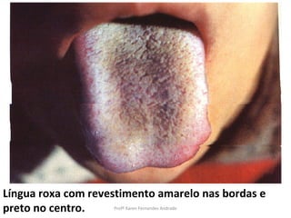 Língua roxa com revestimento amarelo nas bordas e
preto no centro.    Profª Karen Fernandes Andrade
 