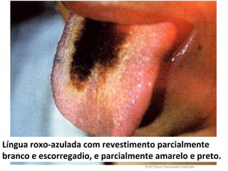 Língua roxo-azulada com revestimento parcialmente
branco e escorregadio, e parcialmente amarelo e preto.
                                   Profª Karen Fernandes Andrade
 