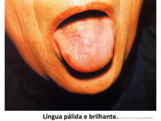 Língua pálida e brilhante.   Profª Karen Fernandes Andrade
 