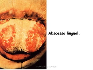 Abscesso lingual.




Profª Karen Fernandes Andrade
 
