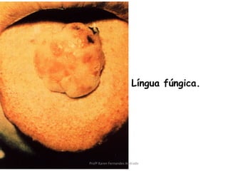 Língua fúngica.




Profª Karen Fernandes Andrade
 