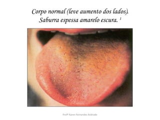 Corpo normal (leve aumento dos lados).
  Saburra espessa amarelo escura. 1




            Profª Karen Fernandes Andrade
 