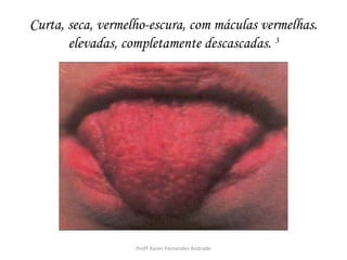 Curta, seca, vermelho-escura, com máculas vermelhas.
       elevadas, completamente descascadas. 3




                   Profª Karen Fernandes Andrade
 