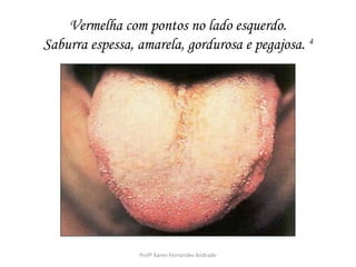 Vermelha com pontos no lado esquerdo.
Saburra espessa, amarela, gordurosa e pegajosa. 4




                 Profª Karen Fernandes Andrade
 