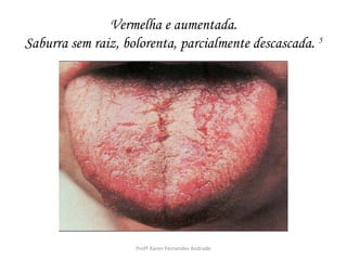 Vermelha e aumentada.
Saburra sem raiz, bolorenta, parcialmente descascada. 5




                    Profª Karen Fernandes Andrade
 