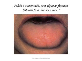 Pálida e aumentada, com algumas fissuras.
       Saburra fina, branca e seca. 6




             Profª Karen Fernandes Andrade
 