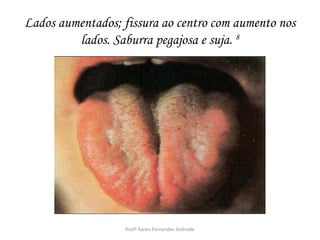 Lados aumentados; fissura ao centro com aumento nos
         lados. Saburra pegajosa e suja. 8




                   Profª Karen Fernandes Andrade
 