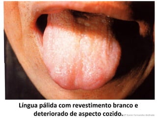 Língua pálida com revestimento branco e
     deteriorado de aspecto cozido.
                                 Profª Karen Fernandes Andrade
 