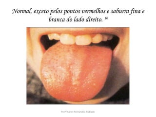 Normal, exceto pelos pontos vermelhos e saburra fina e
              branca do lado direito. 10




                    Profª Karen Fernandes Andrade
 