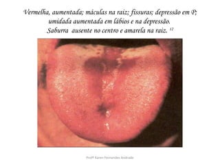 Vermelha, aumentada; máculas na raiz; fissuras; depressão em P;
        umidada aumentada em lábios e na depressão.
        Saburra ausente no centro e amarela na raiz. 12




                      Profª Karen Fernandes Andrade
 