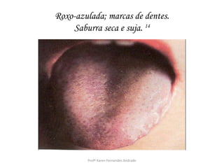 Roxo-azulada; marcas de dentes.
    Saburra seca e suja. 14




        Profª Karen Fernandes Andrade
 