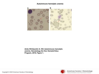 Autoimmune hemolytic anemia
Anita Hill,Quentin A. Hill, Autoimmune hemolytic
anemia, Hematology Am Soc Hematol Educ
Program, 2018, Figure 1.
Copyright © 2023 American Society of Hematology
 