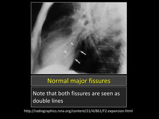 Bulging Fissure Sign Radiology