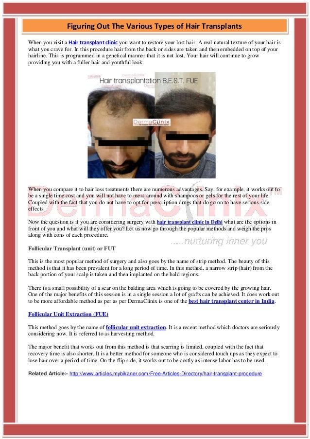 Figuring Out The Various Types Of Hair Transplants