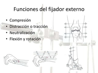 Funciones del fijador externo 
• Compresión 
• Distracción o tracción 
• Neutralización 
• Flexión y rotación 
 