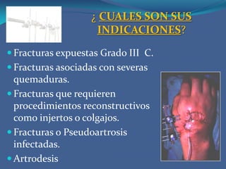 ¿ CUALES SON SUS INDICACIONES?Fracturas expuestas Grado III  C.Fracturas asociadas con severas quemaduras.Fracturas que requieren procedimientos reconstructivos como injertos o colgajos.Fracturas o Pseudoartrosis infectadas.Artrodesis