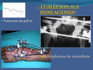 ¿ CUALES SON SUS INDICACIONES?Fracturas de pelvisReimplantes de miembros¿ CUALES SON SUS INDICACIONES?Resecciones óseas tumoralesFracturas multifragmentariasPolitraumatizadosDiscrepancias de miembros inferiores corregibles mediante el alargamiento óseo.Corrección de deformidades angulares y axiales en huesos largos.