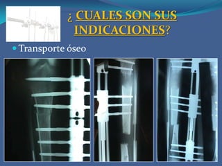 ¿ QUE ES UNA FRACTURA EXPUESTA?