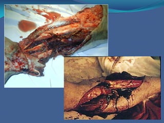 GRADOS DE UNA FRACTURA EXPUESTA( Gustillo y Anderson)