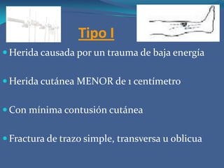 Tipo IIHerida cutánea ENTRE DE 1 - 5 centímetrosCon contusión de partes blandasSin pérdida de hueso ni músculoFractura conminuta moderada