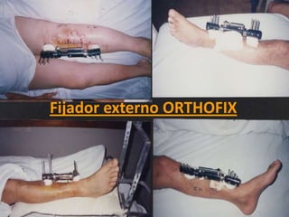 Fijador externo ORTHOFIXModelo de compresion que permite estabilizar la fractura, necesario por la disminución de la longitud del miembroSe logra mediante la osteotomia óseaComponentes: Cabezal en T regulableCabezal rectoTutor general con alargadorTornillos de fijaciónLlaves de calibración de manejo