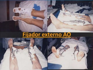 Fijador externo ILIZAROVModelo de mayor rigidez, estabiliza la fractura y proporciona un sistema de compresión, alargamiento y transporte óseo.Se compone de anillos metálicos, guías paralelas que unen los anillos y la fijación al hueso se logra por agujas transfixiantes colocadas en tensión   Se basa en los principios          biológicos de la neohistogénesis por distracción.Fijador externo ILIZAROVTécnicas relacionadas con la manipulación del callo óseo:Transporte óseo   osteotomía en zona metafisaria y cuando se inicie la formación de callo óseo en la zona, se desplaza un segmento de hueso separado por la osteotomía en la dirección adecuada para rellenar el espacio, detrás del cual se formara calloCompresión – distracción   Si la separación no es muy grande, la longitud podrá restaurarse a continuación de la osteotomia y la callostasis en un punto distante del miembro