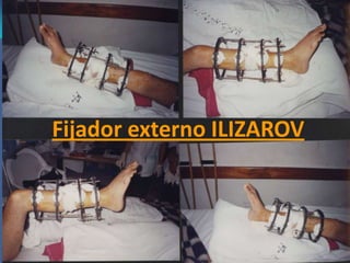 COMPLICACIONESRigidez articularMovilidad anormal del foco de fracturaRetardos de consolidaciónEdema residual Necrosis cutánea Deformidad rotacional 