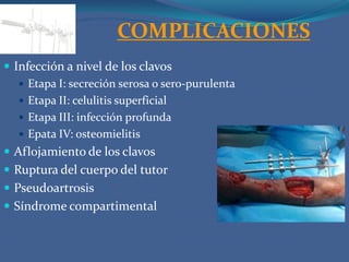 TRATAMIENTO KINESICOPuntos claves en tratamiento kinésicoDolor EdemaLimitación del movimientoAtrofia muscularRigidez articularIncapacidad funcional 
