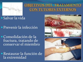 OBJETIVOS DEL  TRATAMIENTO CON TUTORES EXTERNOSSalvar la vidaPrevenir la infecciónConsolidación de la fractura, tratando de conservar el miembroRestaurar la función de la extremidad