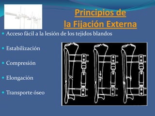 Principios de la Fijación ExternaAcceso fácil a la lesión de los tejidos blandos EstabilizaciónCompresiónElongaciónTransporte óseo