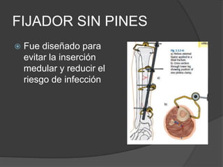 FIJADOR SIN PINES
 Fue diseñado para
evitar la inserción
medular y reducir el
riesgo de infección
 