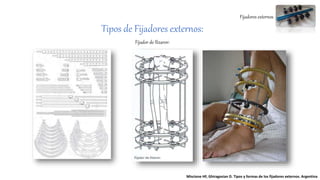Fijadores externos
Tipos de Fijadores externos:
Fijador de Ilizarov:
Miscione HF, Ghiragosian D. Tipos y formas de los fijadores externos. Argentina
 