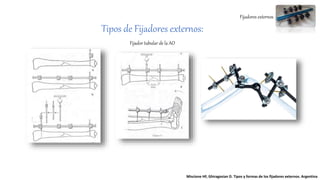 Fijadores externos
Tipos de Fijadores externos:
Fijador tubular de la AO
Miscione HF, Ghiragosian D. Tipos y formas de los fijadores externos. Argentina
 