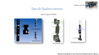 Fijadores externos
Tipos de Fijadores externos:
Sistema de fijación Orthofix
Miscione HF, Ghiragosian D. Tipos y formas de los fijadores externos. Argentina
 