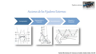 Fijadores externos
Acciones de los Fijadores Externos:
Compresión
Distracción o
Tracción
Neutralización
Flexión y
Rotación
Bucholz RW, Heckman JD. Fracturas en el adulto. Estados Unidos. 231-244
 