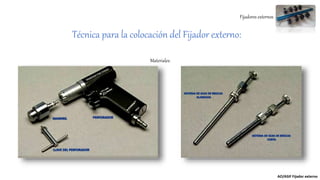 Fijadores externos
Técnica para la colocación del Fijador externo:
AO/ASIF Fijador externo
Materiales:
 