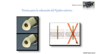Fijadores externos
Técnica para la colocación del Fijador externo:
AO/ASIF Fijador externo
 