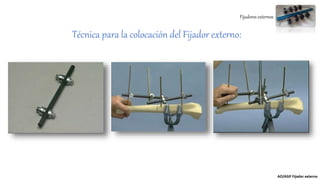 Fijadores externos
Técnica para la colocación del Fijador externo:
AO/ASIF Fijador externo
 