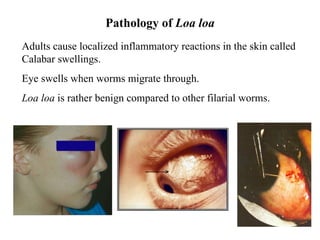 Python Swollen Loaa Skin Inflammation Caused By Loa Loa