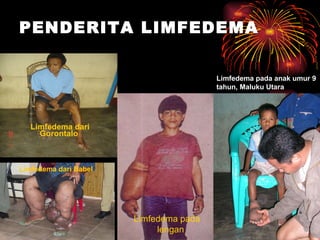 PENDERITA LIMFEDEMA   Limfedema dari Gorontalo  Limfedema pada anak umur 9 tahun, Maluku Utara  Limfedema pada  lengan Limfedema dari Babel 