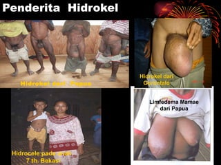Penderita  Hidrokel Hidrocele pada anak  7 th. Bekasi Limfedema Mamae dari Papua Hidrokel dari Gorontalo Hidrokel dari  Papua 