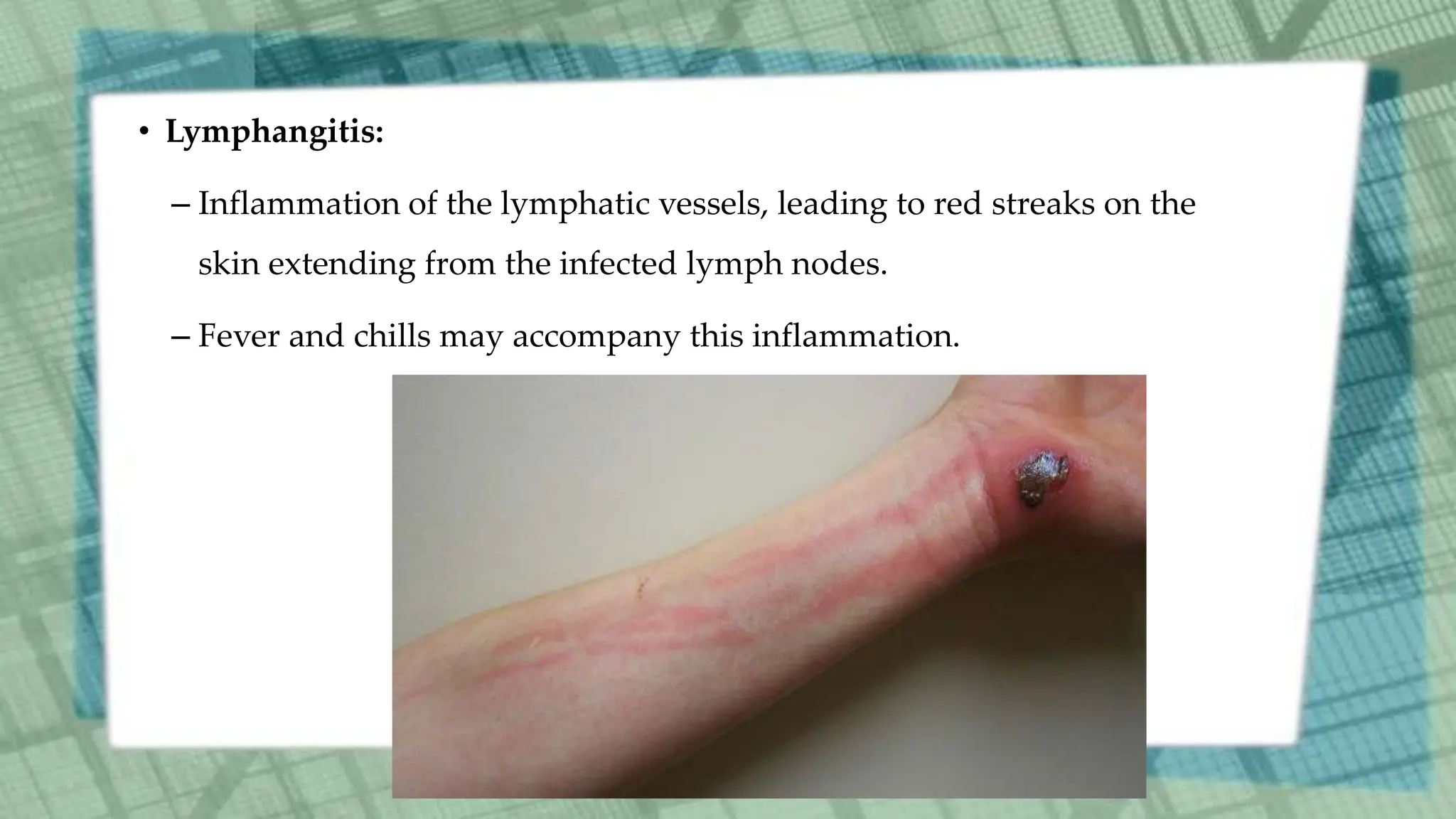 • Lymphangitis:
– Inflammation of the lymphatic vessels, leading to red streaks on the
skin extending from the infected lymph nodes.
– Fever and chills may accompany this inflammation.