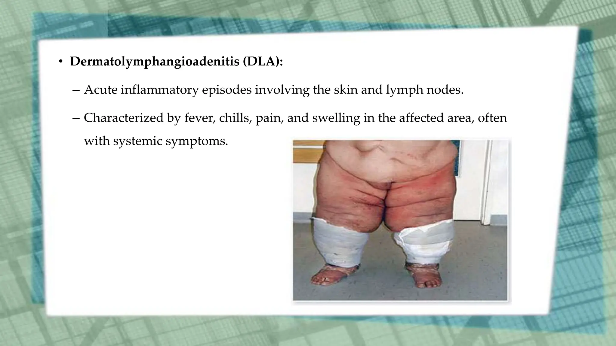 • Dermatolymphangioadenitis (DLA):
– Acute inflammatory episodes involving the skin and lymph nodes.
– Characterized by fever, chills, pain, and swelling in the affected area, often
with systemic symptoms.